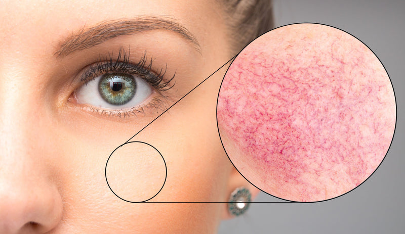 A detailed look into Rosacea Skin Conditions
